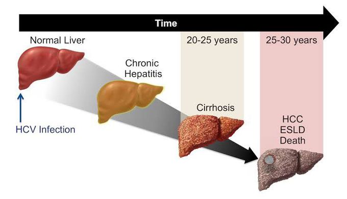 Stages of Hepatitis C