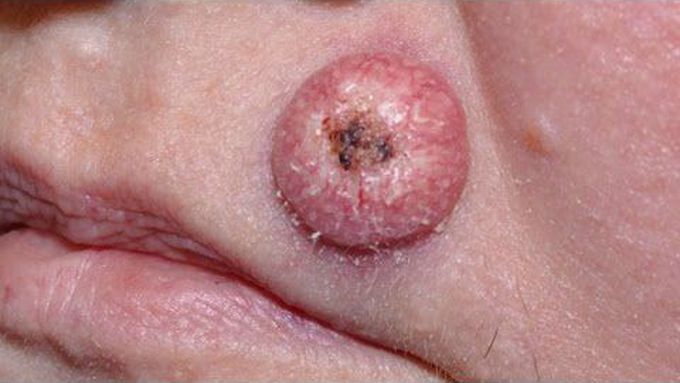 Killer Blackheads