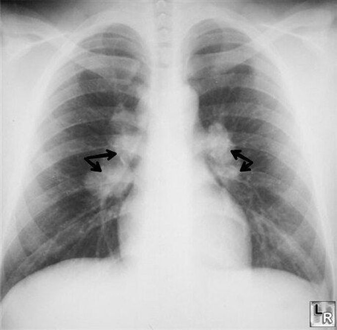 This Chest Radiograph Shows Eggshell Calcification Of The Medizzy