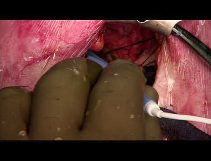 Minimally Invasive Direct Coronary Artery Bypass Grafting & Transcatheter Aortic Valve Implantation