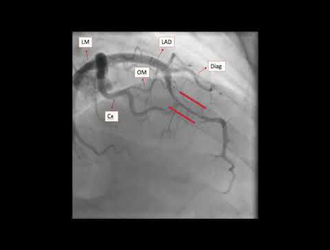 Myocardial Bridge as a Cause of Exertional Chest Pain