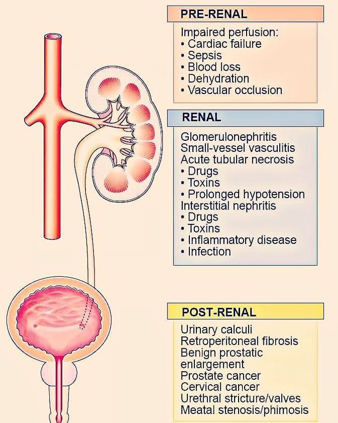 Causes of Acute Kidney Injury.