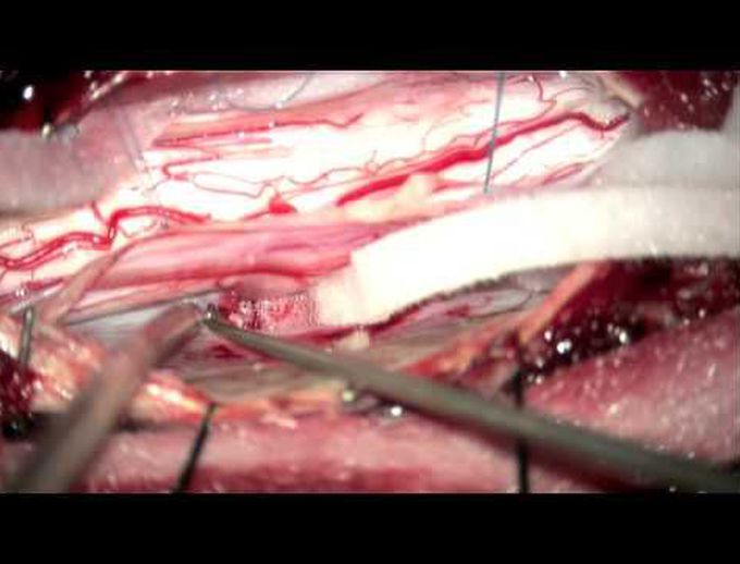 Release and repair of a ventral thoracic spinal cord herniation
