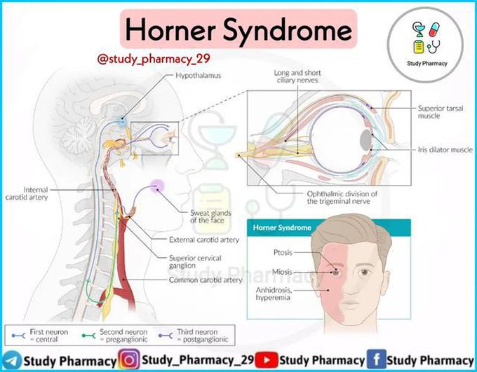 Horner Syndrome