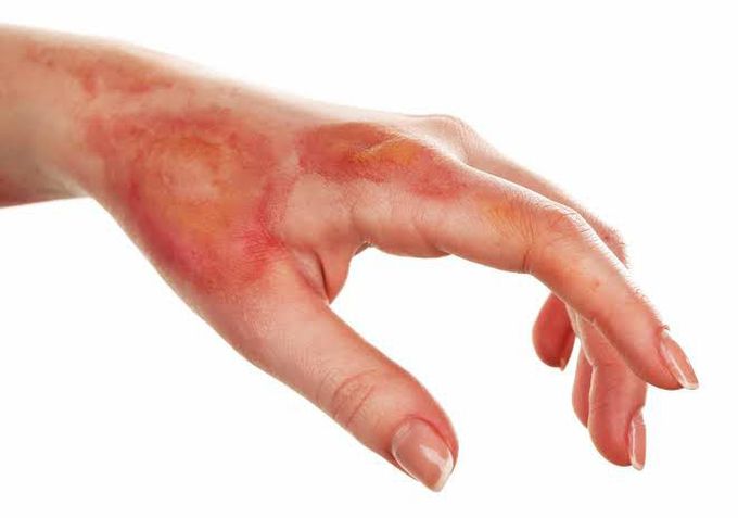 causes of burns