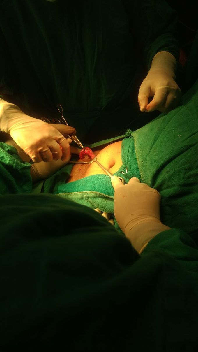 Our first appendectomy. First O.T posting. 3rd year med school. Nepal.
