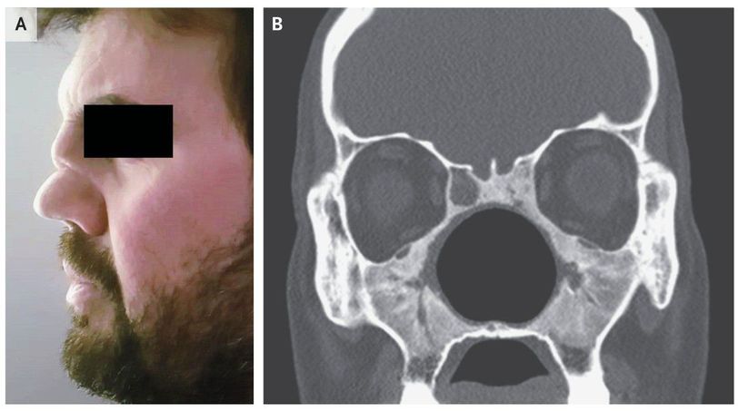 Nasal Deformity In Granulomatosis With Polyangiitis Medizzy