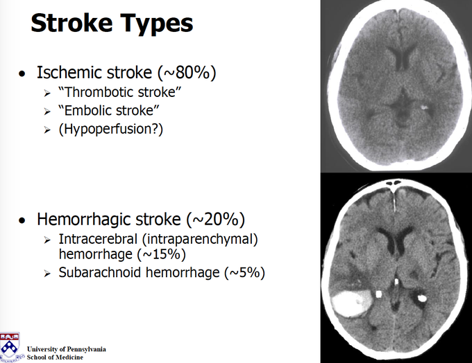 Types of Stroke