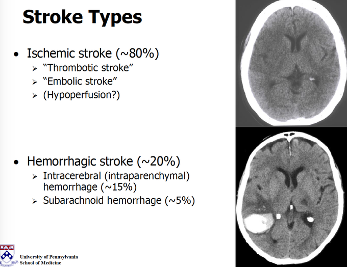 Types of Stroke - MEDizzy