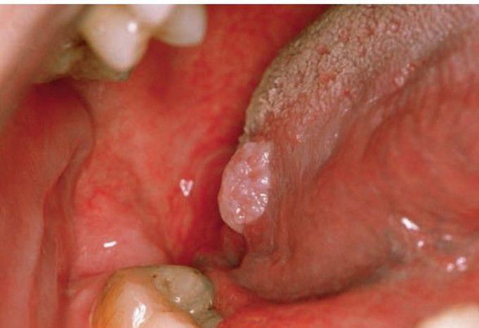 Papilloma on tongue