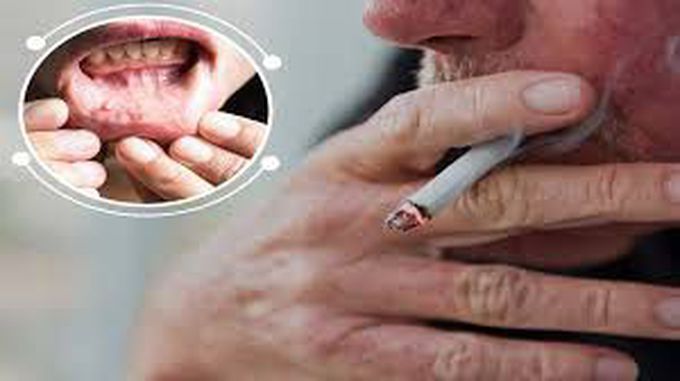 Tobacco And Oral Cancer