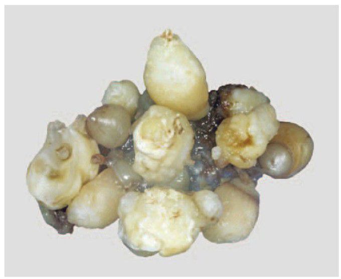 Compound odontoma