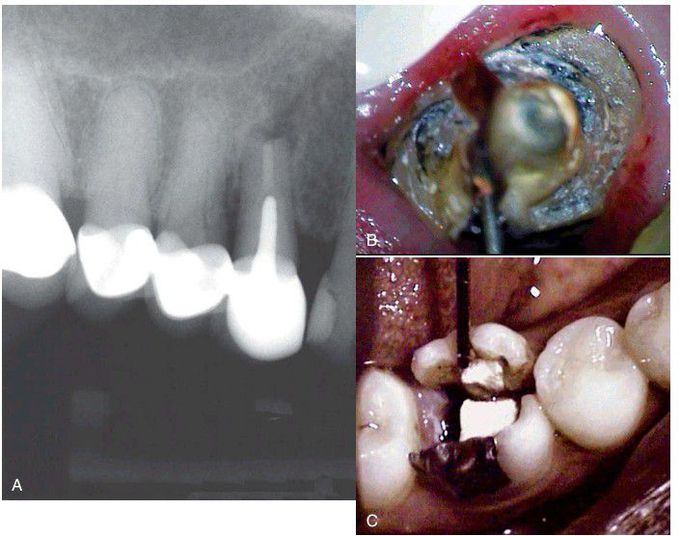 Root fracture