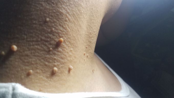 Neck region