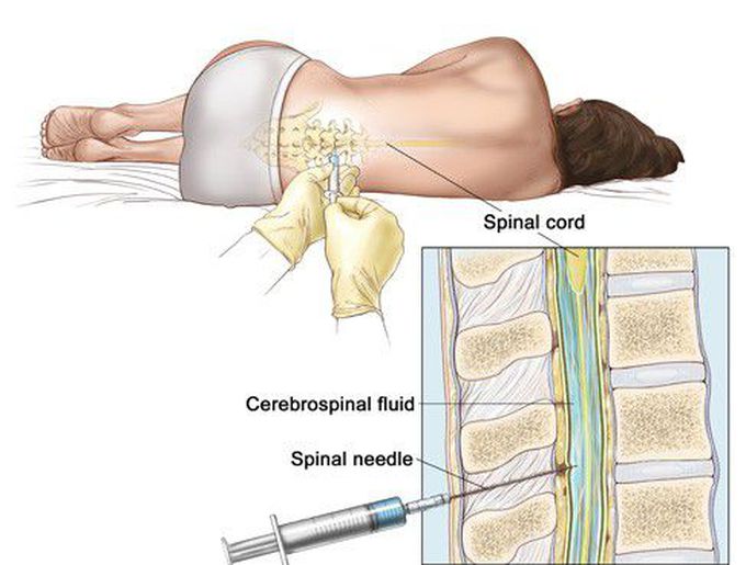 Treatment for Meningococcal Disease