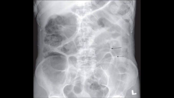 Ascariasis