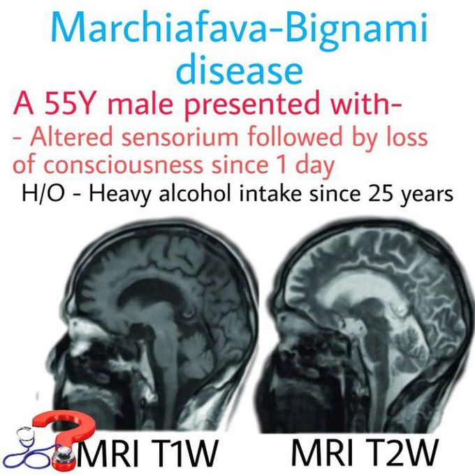Marchiafava-Bignami Disease