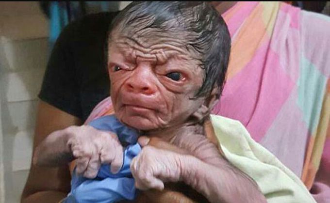 Progeria