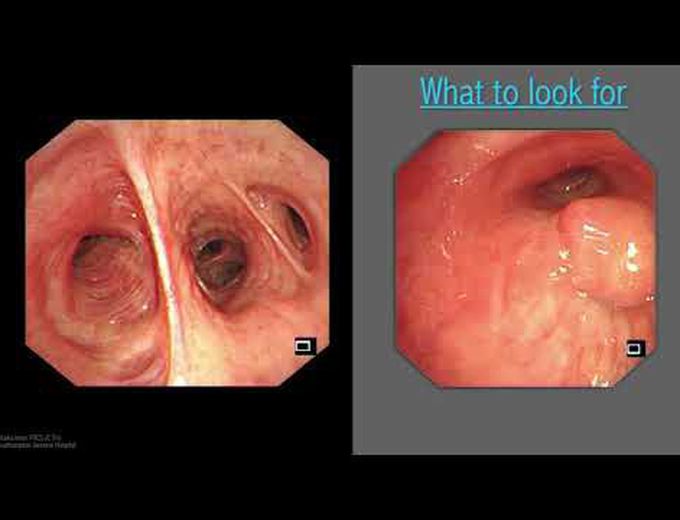 Mastering Bronchoscopy for Thoracic Surgery: Chapter 4