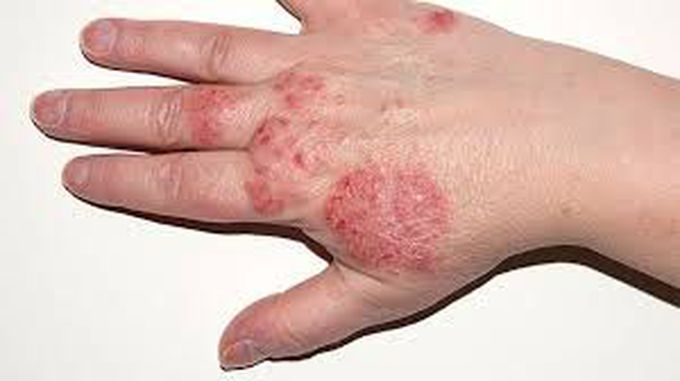 How to treat eczema?