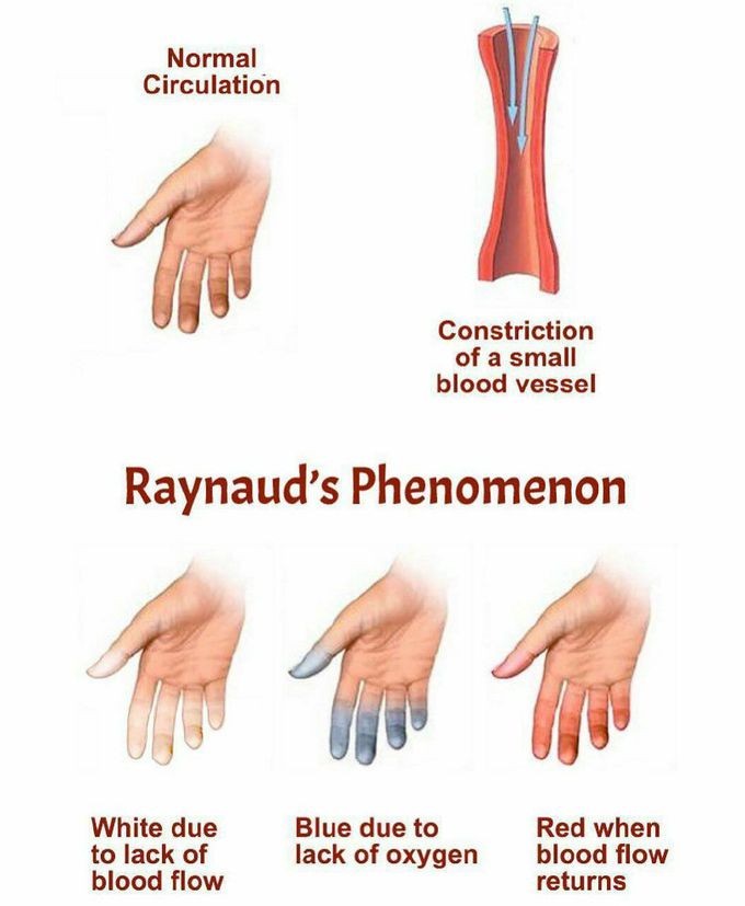Raynaud's phenomenon (RP) is a disorder resulting in vasospasm, a particular series of discolorations of the fingers and/or the toes after exposure to changes in temperature (cold or hot) or emotional events.
The three-phase color sequence (white to blue to red), most often upon exposure to cold temperature, is characteristic of Raynaud's phenomenon.✍