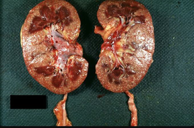 Pyelonephritis