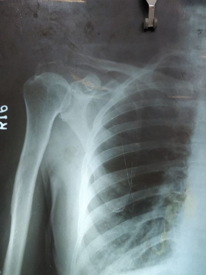 X-ray