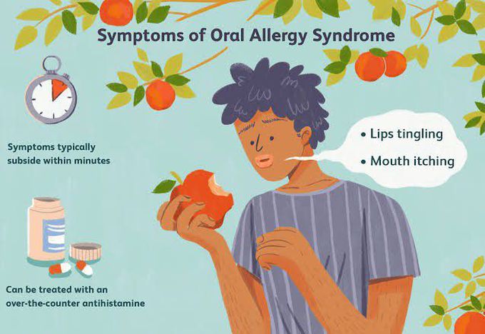 These are the symptoms of Oral allergy syndrome