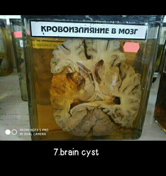 Brain cyst