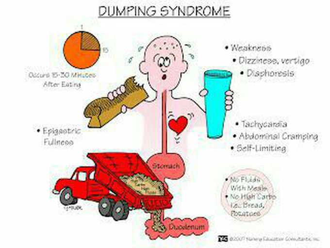 Dumping syndrome