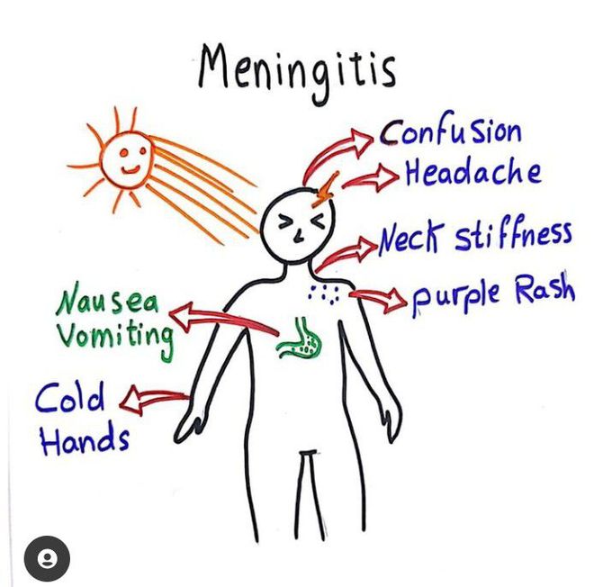 features of meningitis