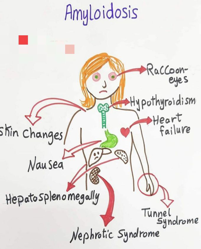 Amyloidosis