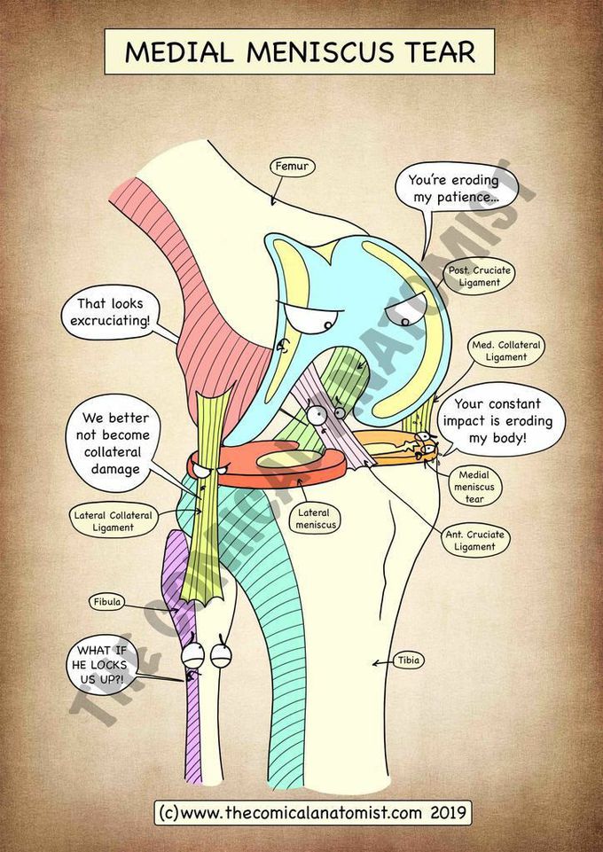 MEDIAL MENISCUS TEAR