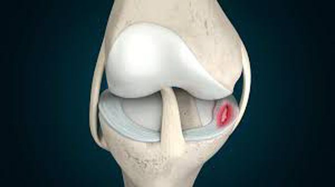 Causes of a Meniscus Tear