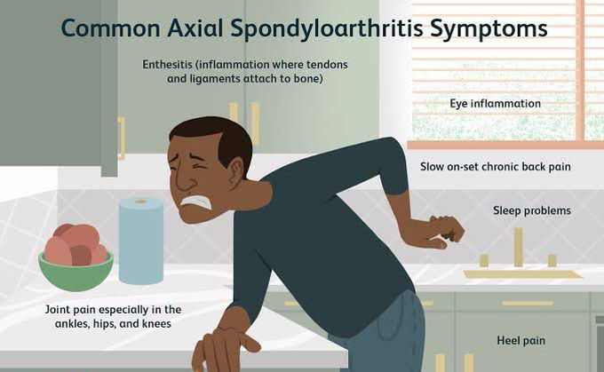 These are the main symptoms of Common axial spondyloarthritis syndrome