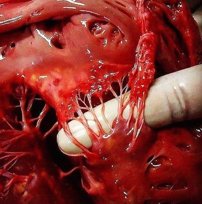 A magnificent shot of Chordae Tendinae and Papillary Muscles