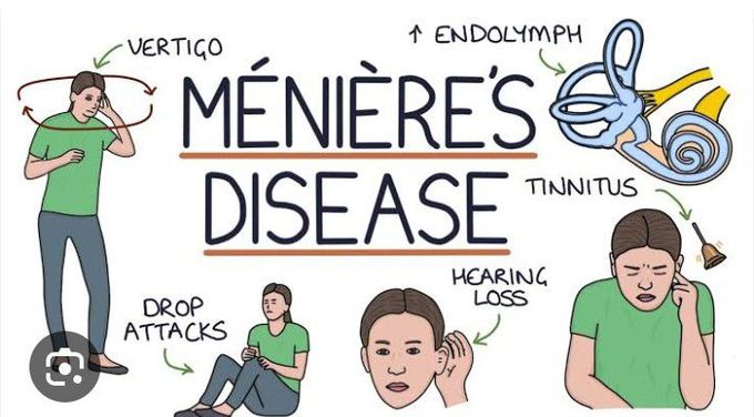 Meniers disease causes