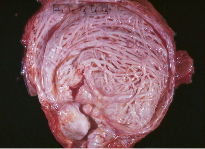 Bladder