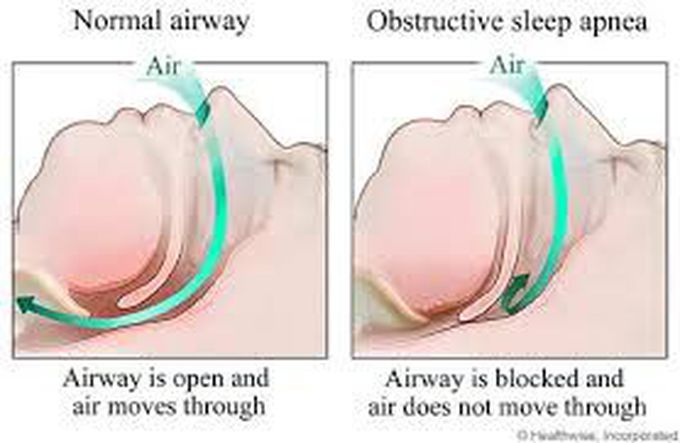 Types of sleep apnea