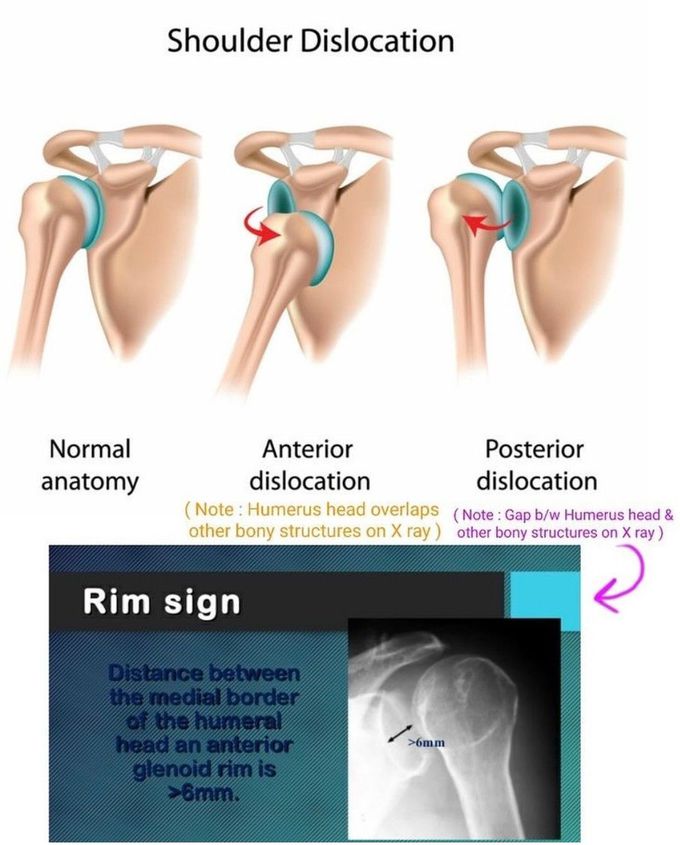 Shoulder Dislocation