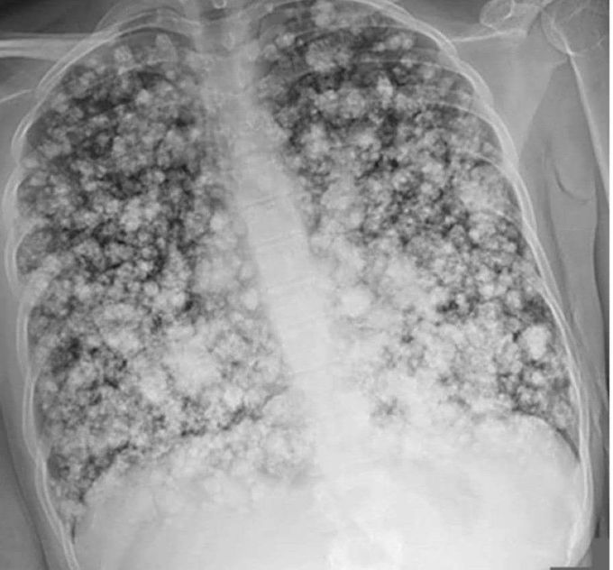 Scary Chest xray ☢️