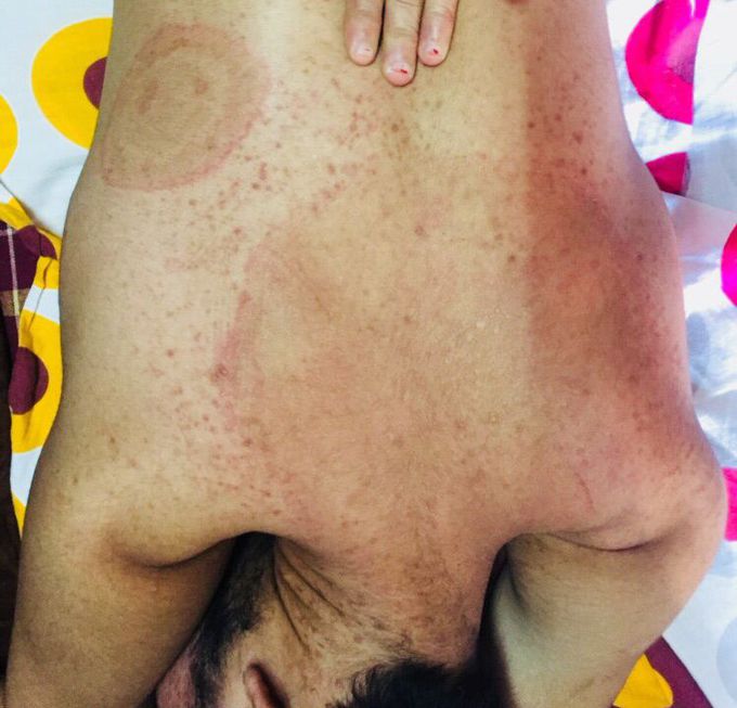 Skin disease 