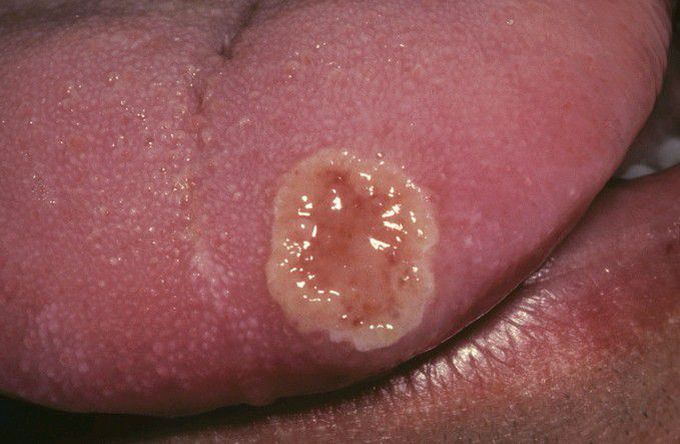 HIV-associated Recurrent Herpetic Infection