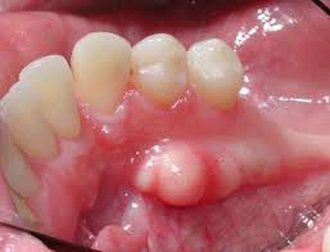 Mandibular Tori