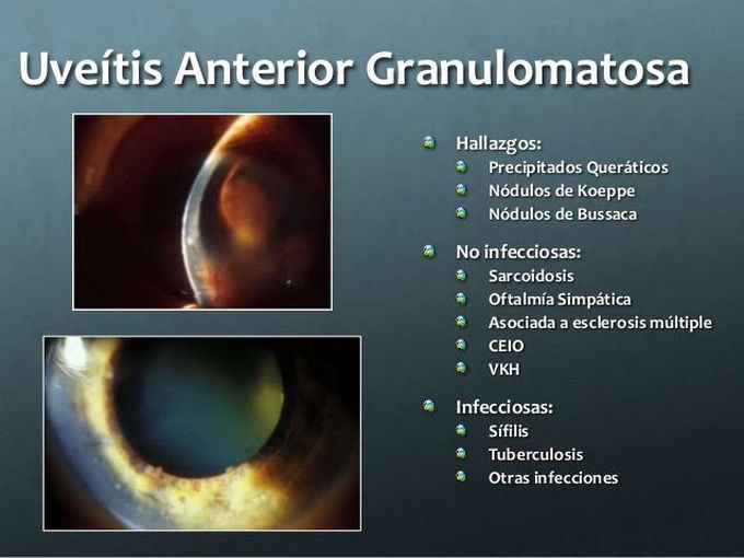 Uveitis anterior