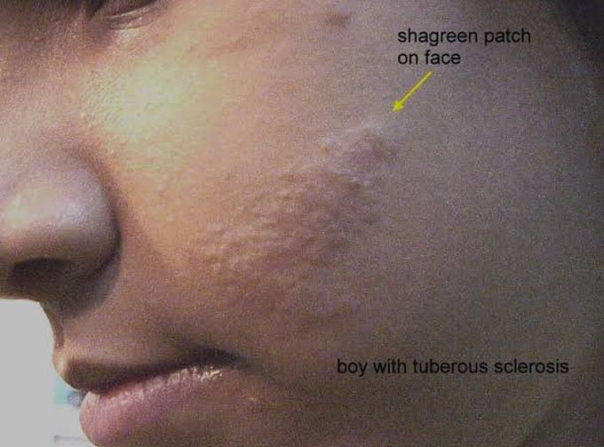 Tuberous sclerosis