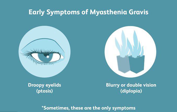 These are the early symptoms of Myasthenia gravis