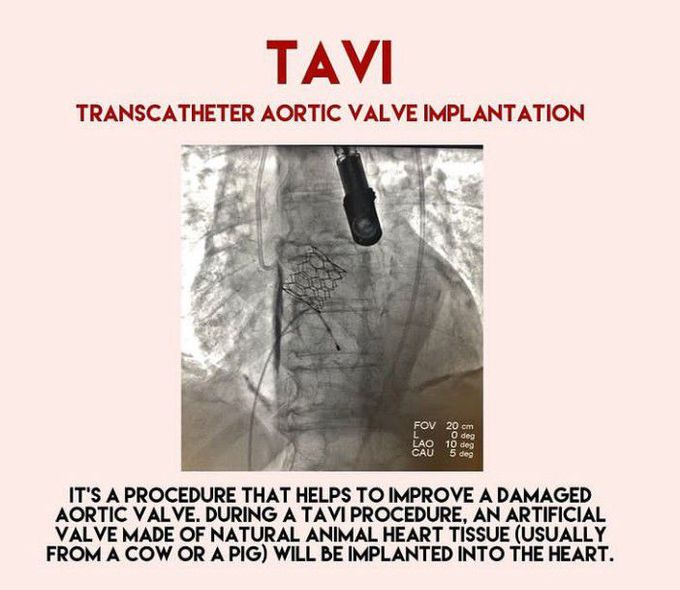 Transcatheter aortic valve implantation (TAVI)