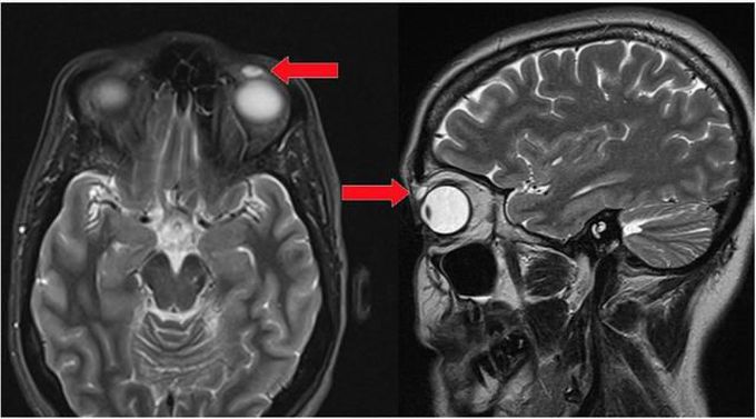 A 'lost' contact lens shows up 28 years later