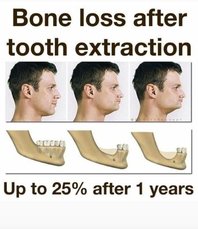 Bone loss after tooth extraction